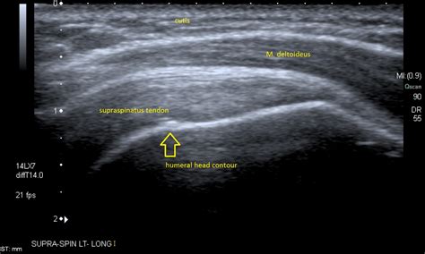 Ultrasound Leadership Academy Intro To Musculoskeletal Ultrasound — Em