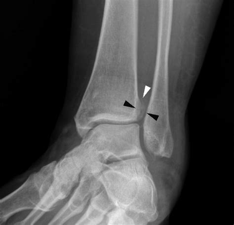 The Proximal Fibula Should Be Examined In All Patients With Ankle