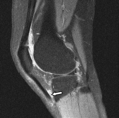 Deep Infrapatellar Bursitis Pacs