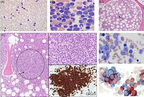 Chronic Myelomonocytic Leukemia 2020 Update On Diagnosis Risk