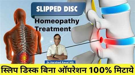 Slip Disc Homeopathic Medicine Trevor Walker