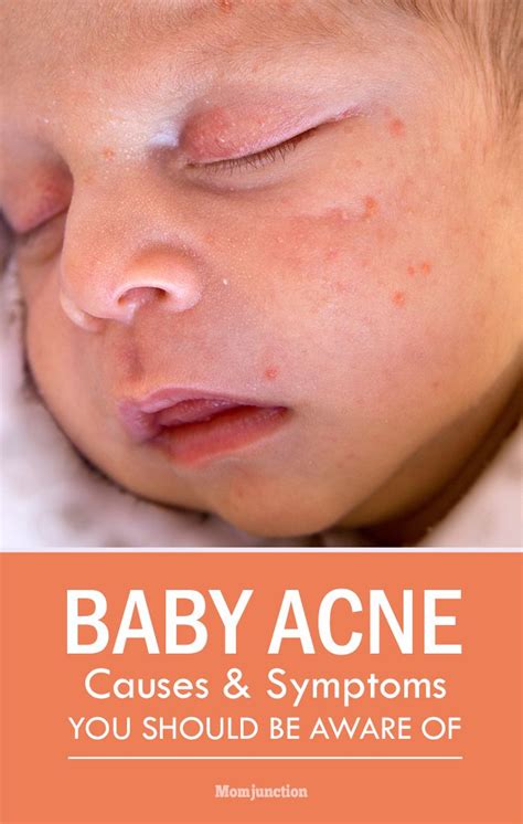 Baby Acne What Causes Them And How You Can Prevent Baby Acne