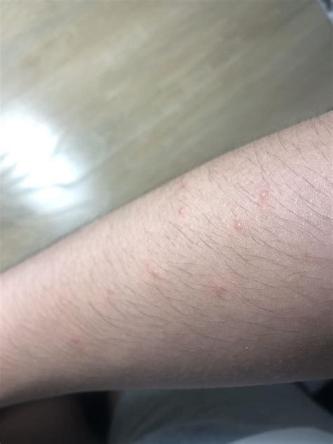 Small Itchy Red Bumps On Forearm Rdermatologyquestions
