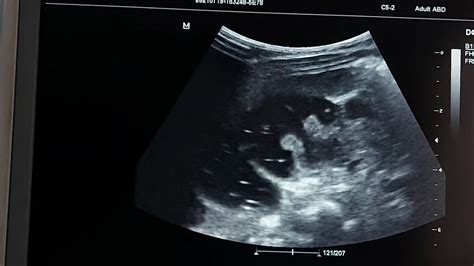 Intussusception Hydrostatic Reduction Under Ultrasound Guidance Youtube