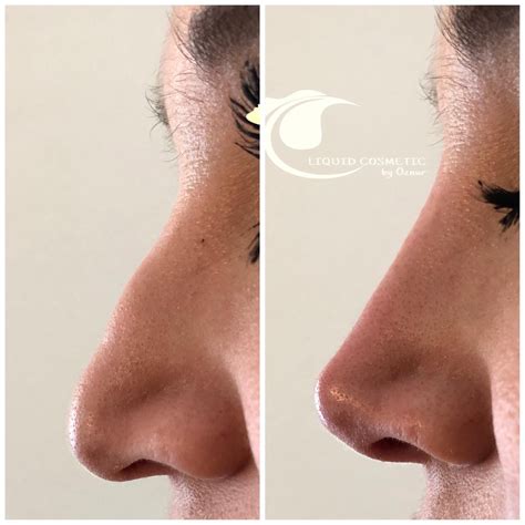 Non Surgical Nose Job After 1 Year Big Shot Webcast Picture Gallery