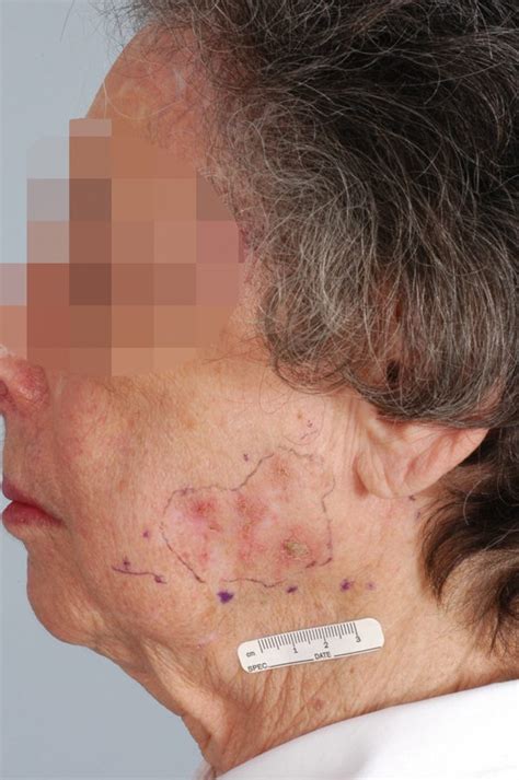 Washington Dc Skin Cancer Before And After Photos Mclean Va Plastic