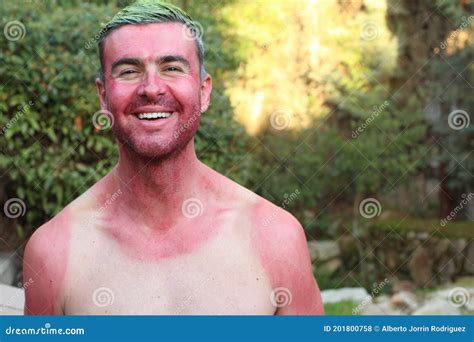 Man With Pale Complexion Getting Sunburnt Stock Photo Image Of Lotion