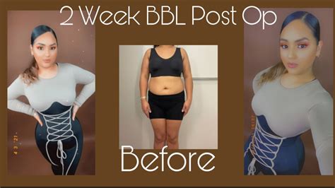 Bbl 2 Week Post Op Update Body Reveal Bbl Arm And Chin Lipo 305 Plastic Surgery Youtube