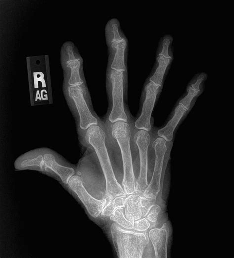 Xrays Of Hand Arthritis