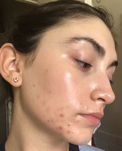 My Personal Journey Taking Spironolactone For Acne Popsugar Beauty Uk