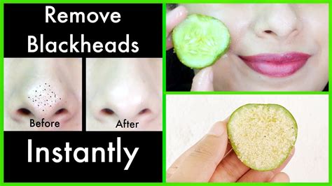 Magic Remedy To Remove Blackheads From Nose At Home Youtube
