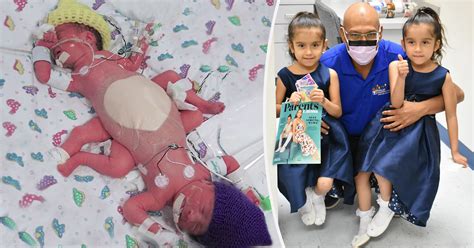 Formerly Conjoined Twins Thriving 5 Years After Separation Reunite With