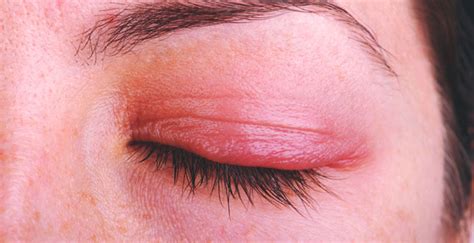 Eyelid Inflammation Blepharitis Causes Symptoms Treatments