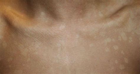 Tips On Dealing With White Spots Naturally Health Digezt Skin Spots
