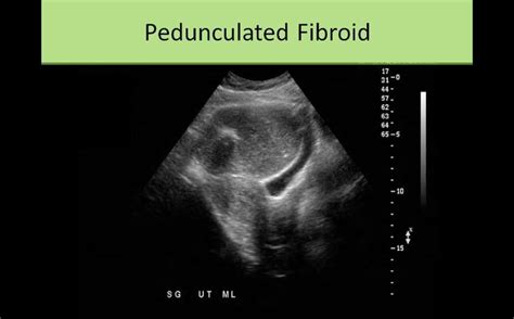 Pedunculated Fibroid Diagnostic Medical Sonography Sonography Fibroids