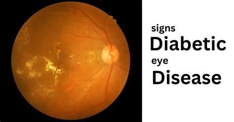 Signs Of Diabetic Eye Disease All About Your Eyes