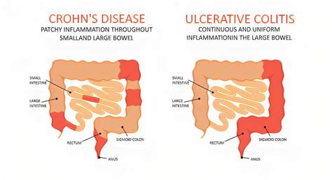 Ulcerative Colitis Uc Causes Symptoms Types Diagnosis And Treatment