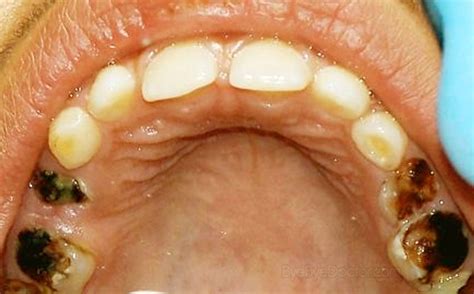 Tooth Decay Causes Symptoms Causes Treatment And Prevention Of Diseases