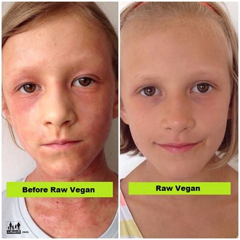 Raw Food Skin Before And After Transformation With Photos