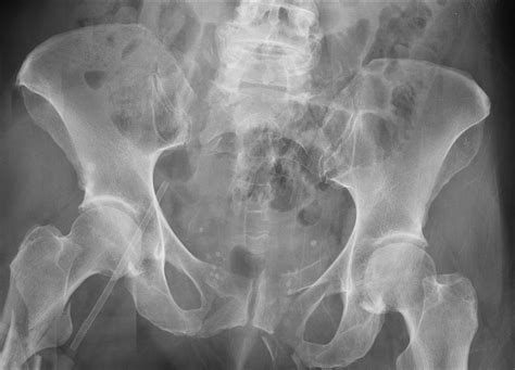 Pelvic Ring Fractures Trauma Orthobullets