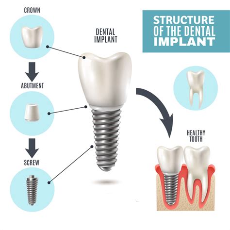 Dental Implants Spring Dental