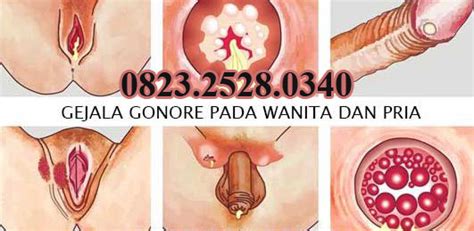 We did not find results for: Contoh Sipilis Pada Pria / Tanda Tanda Penyakit Sipilis ...