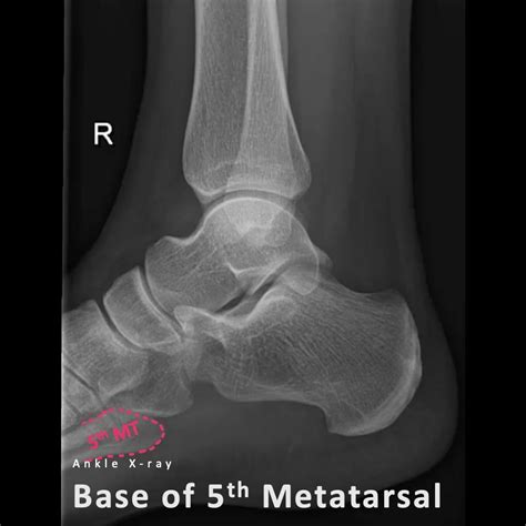 Approach To Lateral Radiograph Of The Ankle Pulse Md