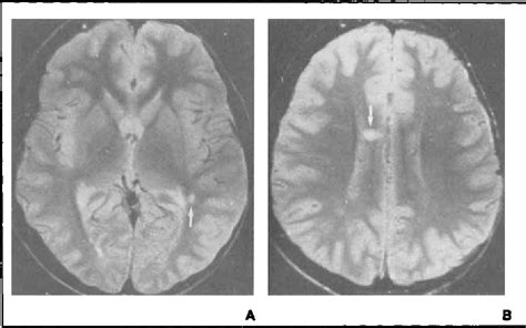 Figure 1 From Mri Detects Cerebral Involvement In Neurologically