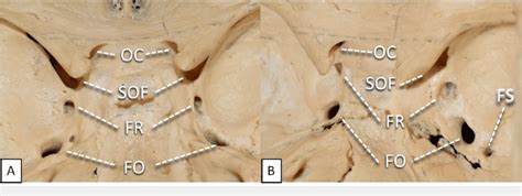 Close Up View Of Cranial Nerve Foramina Within Middle Cranial Fossa A
