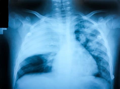 Increase Pneumonia Risk In Asthma With Inhaled
