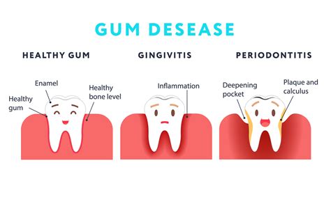 Gum Disease Explained Signs Symptoms And Treatments