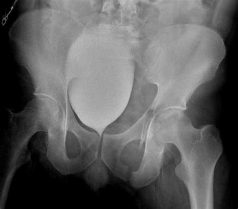 Acetabular Fractures Trauma Orthobullets