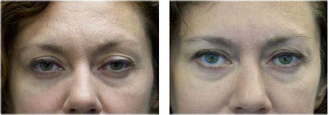 Botox Used To Treat Ptsosis Droopy Eyelid By Dr Christine Hamori