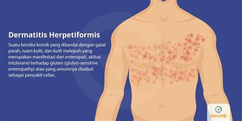 Dermatitis Herpetiformis Tanda Dan Gejala Penyebab Cara Mengobati Sexiz Pix
