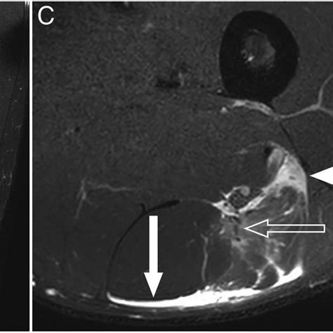 Longitudinal Tear In The Intramuscular Biceps Femoris Tendon A Mri