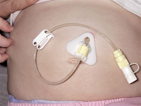 Long Term Gastrostomy Tubes May Increase Stomach Fistulas