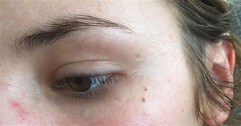 What Are These Little White Bumps Under My Eyes Imgur