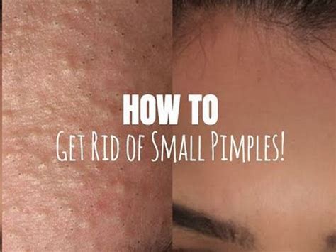 What Should You Do For Small Tiny Pimples On Face Pimples On Face