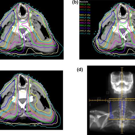 Optimization Of The Volumetric Modulated Arc Therapy Vmat Planning