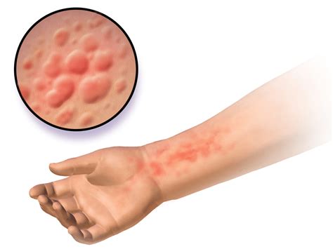 Immune Inhibiting Therapy For Common Eczema Shows Promise