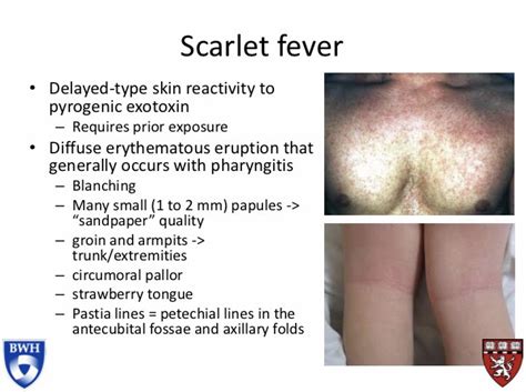 Scarlet Fever Delayed Type Skin Reactivity To Pyrogenic Grepmed