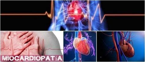 Miocardiopatía Definición Signos Síntomas Causas Mecanismo