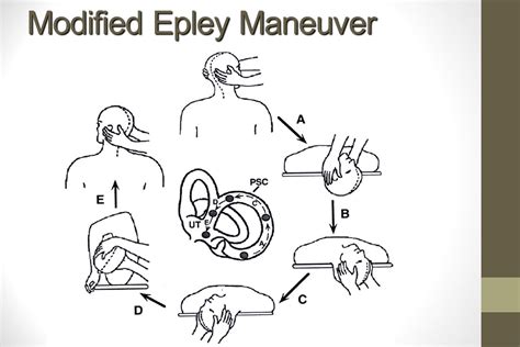 Home Epley Maneuver Handout Insurance Nay