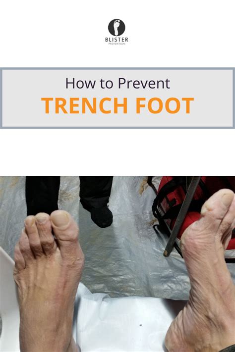 Maceration Part 3 Preventing Maceration Prevention Foot Injury