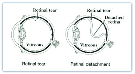 Maybe you would like to learn more about one of these? Retina Health Center Retinal Tear and Detachment