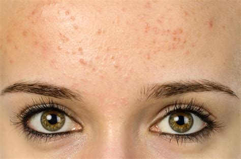 Top 11 How To Cure Small Acne On Face In 2022