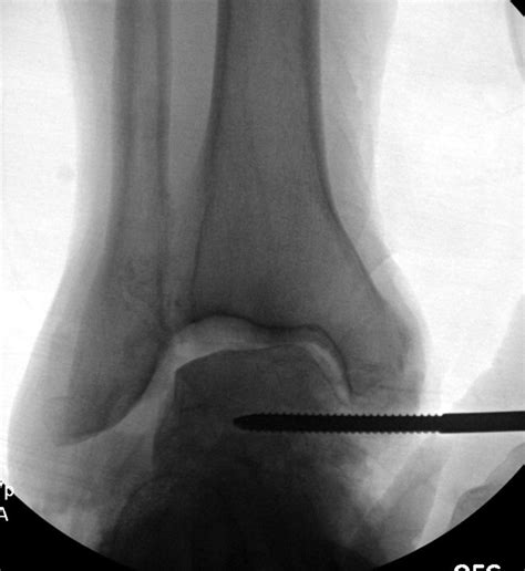 Total Ankle Replacement With Severe Valgus Deformity Technique And