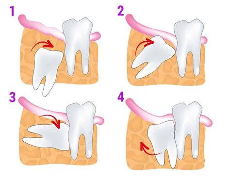 What Is The Purpose Of Wisdom Teeth Boston Dentist Congress Dental