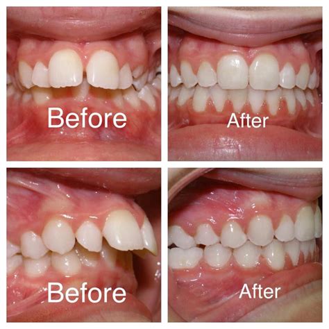 Orthodontist Braces Before And After