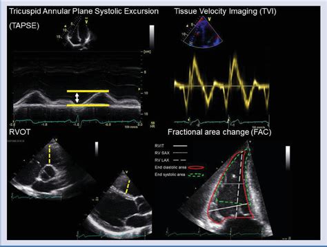 Figure 1 From Current And Future Role Of Echocardiography In